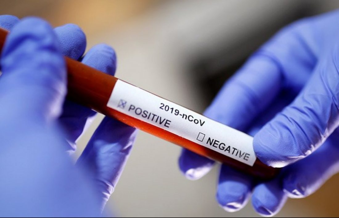 ПЛР-діагностика підтвердила коронавірус у померлої з Новомиргорода