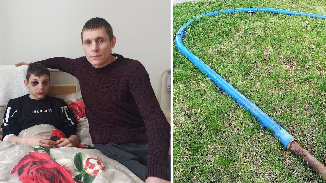 На Кіровоградщині на підлітка впала гойдалка, в нього &#8211; переломи кісток черепа