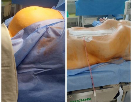 Кропивницькі лікарі видалили  жительці Херсона пухлину вагою 17 кг. ФОТО